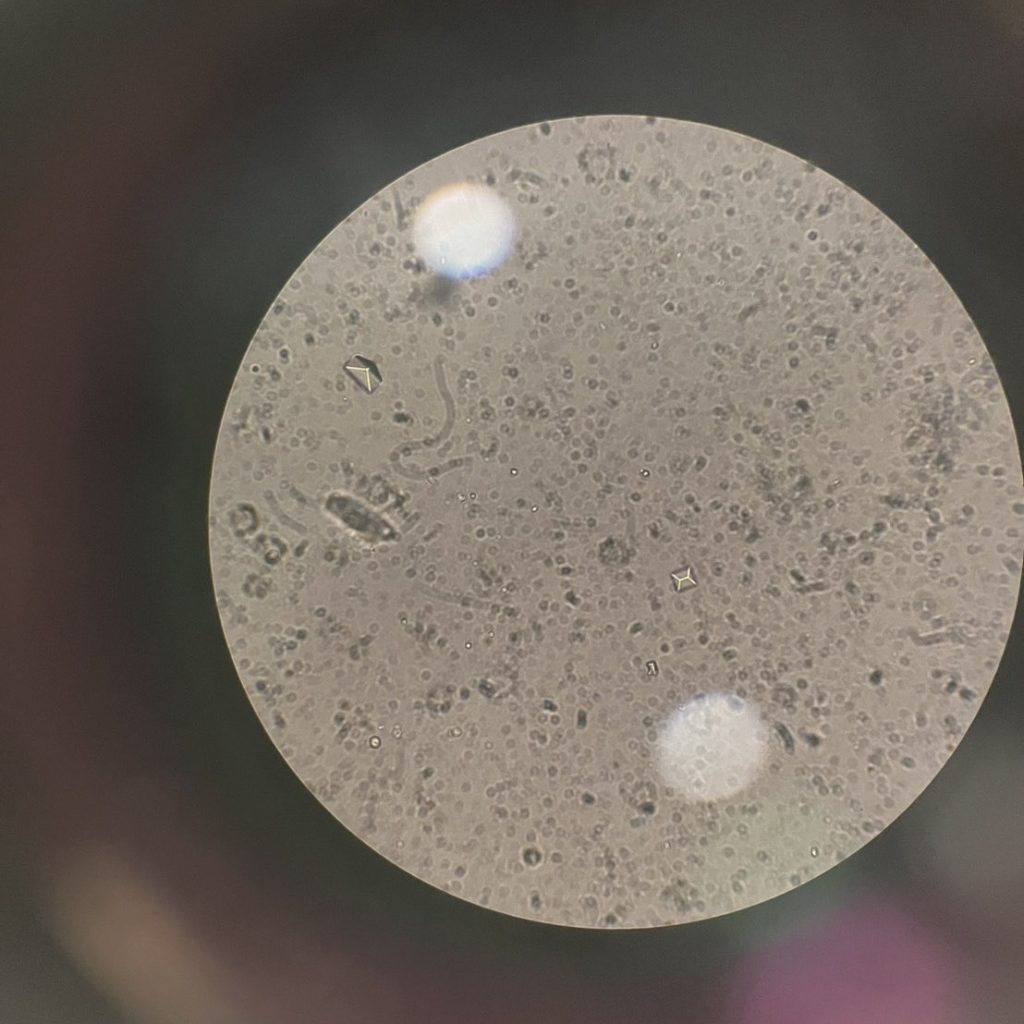 超音波顯示有結石