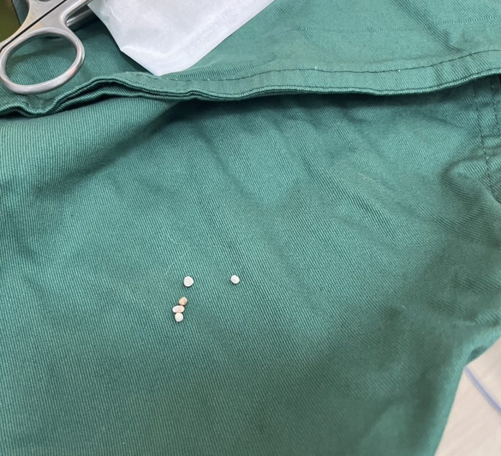 取出的五顆結石