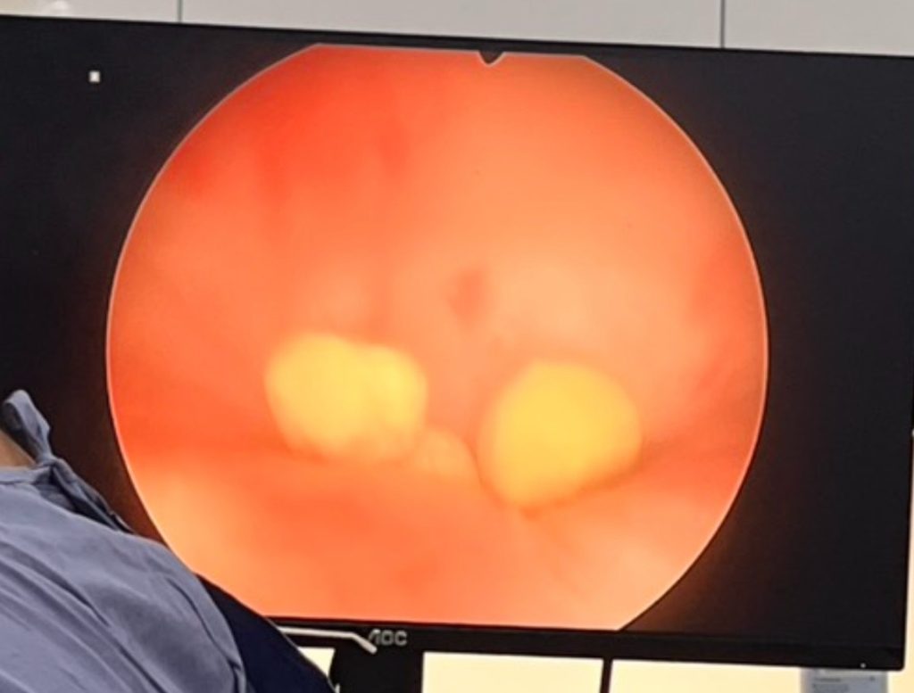 膀胱內視鏡手術