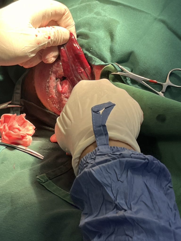 術中紅腫的膀胱