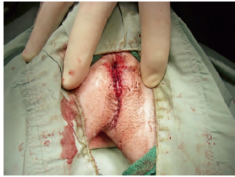 完成手術後的照片