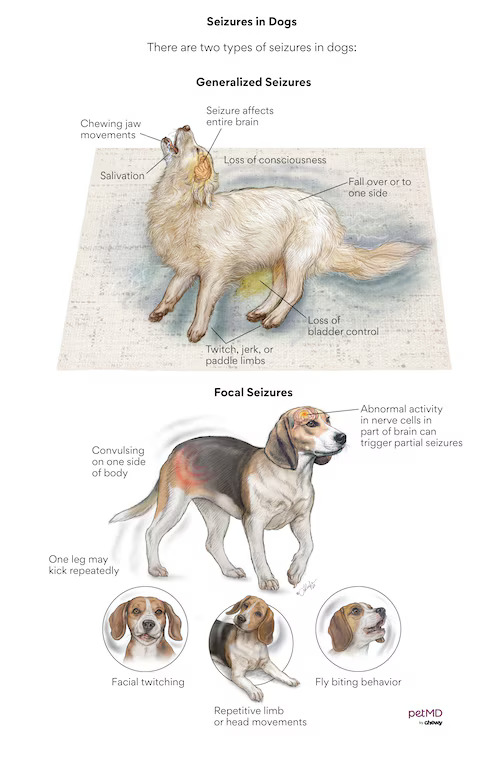 全身癲癇發作和局部癲癇發作對照圖