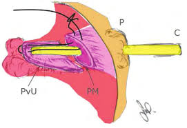 尿道造口示意圖