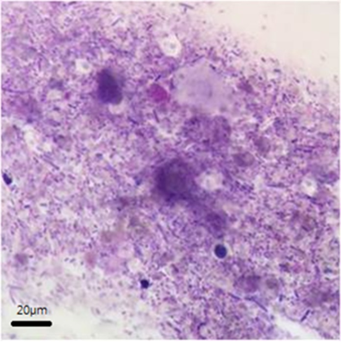糞便檢查發現細胞過度生長。