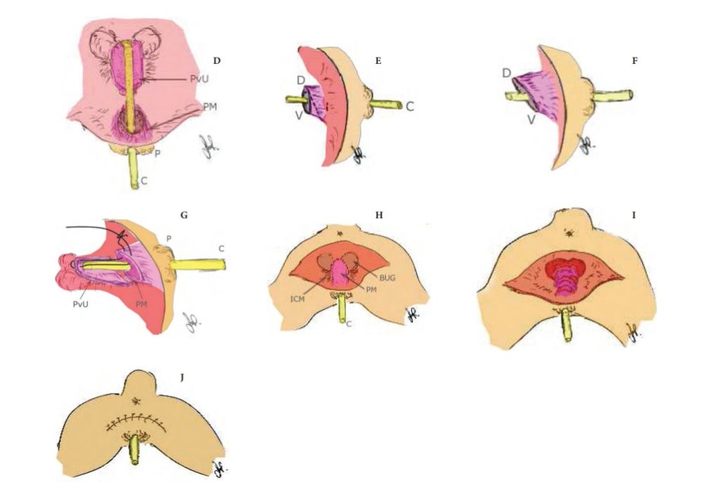 尿道造口手術示意圖